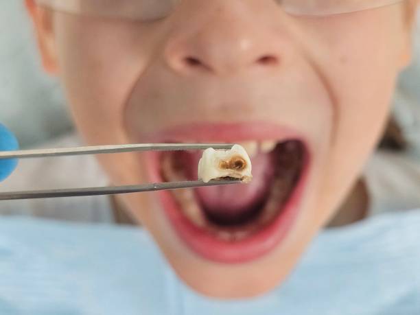 Best Emergency Tooth Extraction in Conway, SC